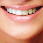 teeth-whitening-results2